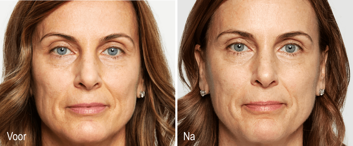 Sculptra gelaat behandeling Clinic Essence