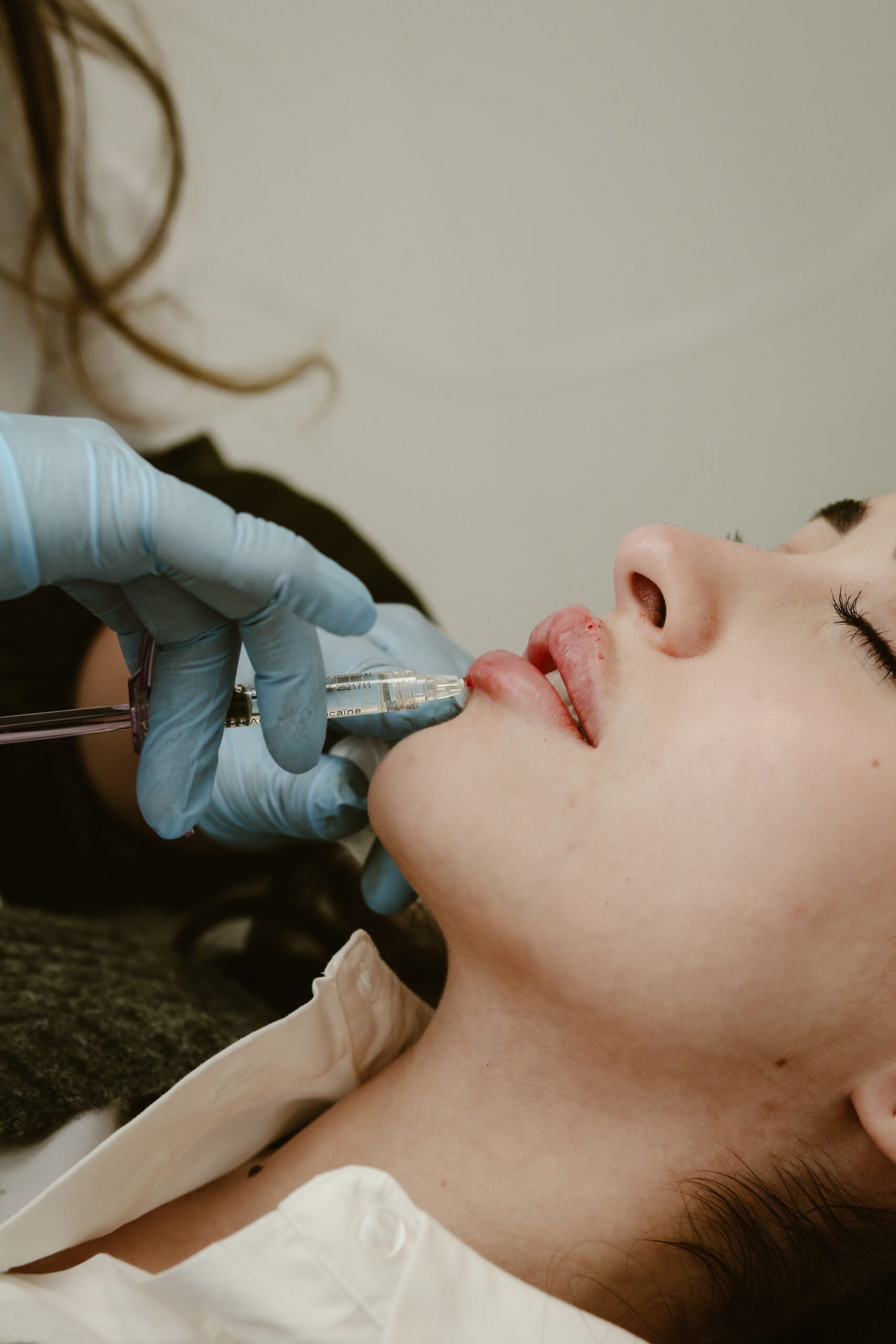 Informatie over fillers Clinic Essence