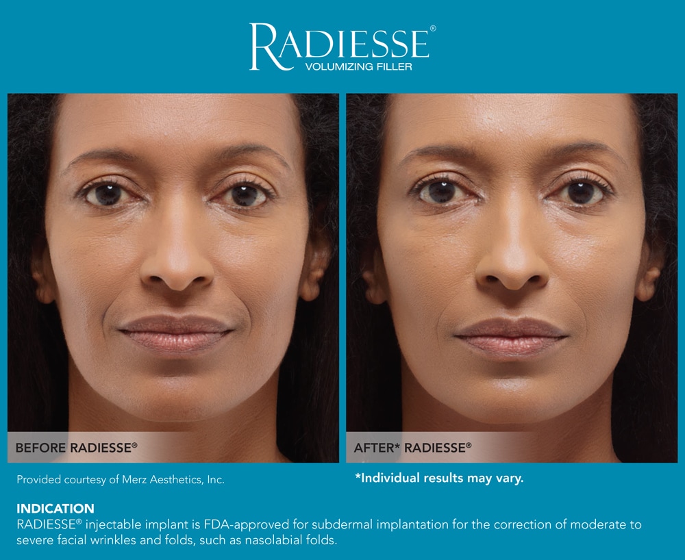 RADIESSE lichaam behandeling Clinic Essence
