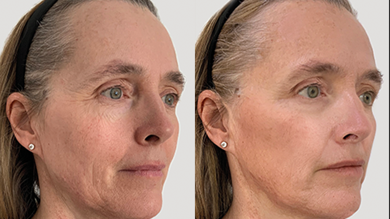Profhilo Structura behandeling Clinic Essence